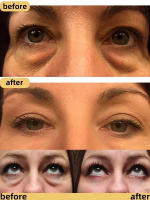 Crema para los Ojos Removedor de Granulos de Grasa Mejora la Firmeza y Iluminación - details 4