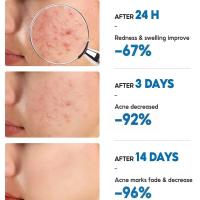 Crema Reparadora de Acné Efectiva Control de Aceite de Poros, Hidratación, Limpieza Profunda - details 8