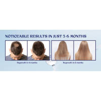 5% Minoxidil Beard Growth Serum