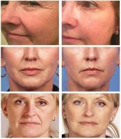 Retinol-Juego de suero Facial eliminador de arrugas, crema antienvejecimiento reafirmante instantánea, blanqueamiento de líneas finas, cuidado hidratante de la piel - details 3