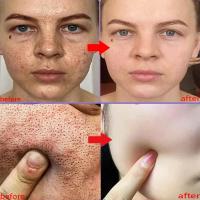 Crema Reductora de Poros de Ácido Salicílico Adiós a los Pulgares, Reparación de Piel, Estiramiento - details 1