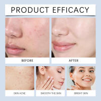 Limpiador de ácido salicílico para limpieza facial, blanqueamiento de poros, reducción del acné, cuidado hidratante suave - details 10