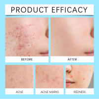 Retinol limpia ligeramente el cuidado del acné facial mejora el gel de gel para la piel - details 8