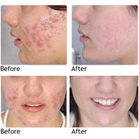 Té verde Original, elimina profundamente los puntos negros, mascarilla de barro para acné, palo, reduce los poros, disipa la crema para el acné, trata las espinillas, cuidado coreano de la piel limpia - details 11