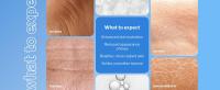 hydroquinone cream, hylunaric acid serum, hyperpigmentation treatment, instant face lift cream, face