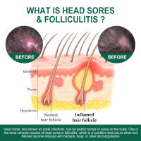 Cuero cabelludo limpieza profunda folículos caspa reparación cabello suavizante esencia de cuidado - details 8