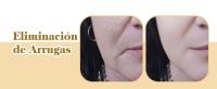 Masajeador Facial, Antiedad LED Luz Roja Terapia Masajeador Cara, Máquina Facial para Antiarrugas y Reafirmante, Rejuvenecimiento Facial, Cuidado Facial - details 9