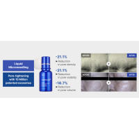 microneedle, Zero exosome shot, Lacto exosome, instant pore-tightening care, Pore Refining serum