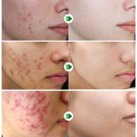 Crema Reparadora de Acné Efectiva Control de Aceite de Poros, Hidratación, Limpieza Profunda - details 18