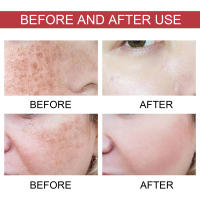 Niacinamida, suero para eliminar manchas oscuras, pecas faciales, melanina, corrector, hidratante, brillo, antipigmentación, reparación, cuidado de la piel - details 2