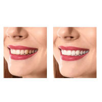 Kit de blanqueamiento dental con lámpara, 32LED - details 5