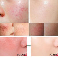 Crema de día correctora antienrojecimiento Facial, crema para el cuidado de la piel sensible a la picazón, crema hidratante para iluminar la Base, cosméticos - details 1