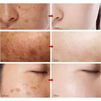 Crema para eliminar manchas blanqueadoras de Ácido Kójico, elimina el melasma, corrección de melanina, mejora la piel, aclara las manchas oscuras, cosméticos - details 0