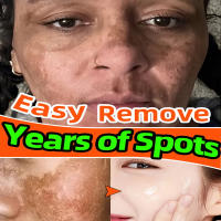 Crema Blanqueadora Efectiva para Manchas Negras Anti-Manchas, Desvanecimiento de Pigmentación, Iluminación del Piel Herramienta de Cuidado de la Piel Corporal de Belleza - details 0