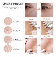 Herramienta Para Quitar Verrugas, Pluma Cauterizador - details 6