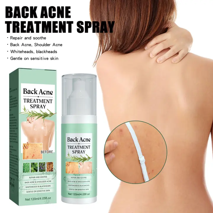 Spray reparador de acné en la espalda, aceite esencial para eliminación de acné, tratamiento de acné, Spray que se desvanece, marcas de acné, crema para el cuidado de la piel para todo tipo de piel, 120ml - 1