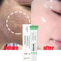 Crema Reductora de Poros de Ácido Salicílico Eliminación Rápida de Pimientas Piel Suave y Lisa - details 13