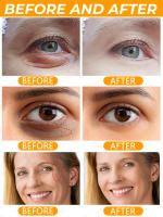 Crema para los Ojos Removedor de Granulos de Grasa Mejora la Firmeza y Iluminación - details 3