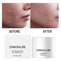 Ungüento contra espinillas: crema antiespinillas también para espinillas en el trasero y la espalda, ungüento para eliminar el acné, regalo - details 2