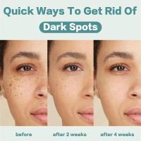 Crema Blanqueadora Potente Elimina Manchas de Melanina Rápido Hidrata y Ilumina la Piel - details 3
