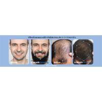 hair regrowth treatment