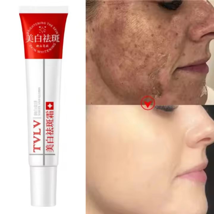 Crema blanqueadora para pecas, melasma, manchas oscuras, producto de eliminación de pigmentación, mancha que se desvanece, melanina, reparación rápida, ilumina el cuidado de la piel coreano - 1