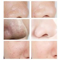 Crema Reductora de Poros de Ácido Salicílico Adiós a los Pulgares, Reparación de Piel, Estiramiento - details 19