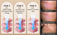 Lámpara de Terapia UVB KTS para Tratamiento de Vitiligo 308NM Luz Ultravioleta de Banda Estrecha para Eczema y Psoriasis Herramienta de Cuidado de la Piel Corporal - details 3