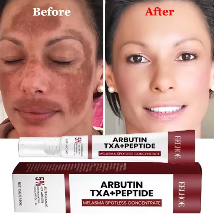 Potente crema blanqueadora que elimina manchas, ilumina la piel, elimina rápidamente la pigmentación de melanina, Melasma, manchas oscuras, cuidado de la piel coreano, nuevo - 1