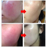 Crema Reparadora para Rojos Hidratante y Calmante para Piel Sensible Adiós a la Piel Seca - details 0