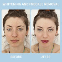 Crema iluminadora de niacinamida y Melasma, crema iluminadora de melanina, aclara la piel oscura, suero de cloasma que desvanece las líneas finas, cuidado facial - details 0