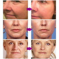 Instantánea Firmación y Elevación de la Piel Removedor de Arrugas Retinol - details 1