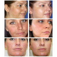 Crema Ligera para Iluminar la Piel de Niacinamida Debilita el Melasma, Desvanece Manchas Fine, Ilumina Piel Oscura Herramientas de Cuidado de la Piel Facial - details 5