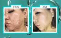 Niacinamide Serum Before and After