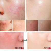 7X suero calmante para enrojecimiento Facial, tratamiento instantáneo de rosácea, venas de sangre rojas, mejora la reparación de la barrera de la piel sensible, cosméticos Coreanos - details 1