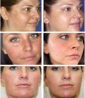 Crema Blanqueadora Astragalus Removedor de Manchas Dark Eyes Reparador de Melasma Hidratante - details 0