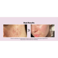 COSRX Niacinamide 15% Face Serum, Minimize Enlarged Pores, Redness Relief, Discoloration Correcting