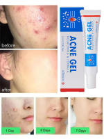 Crema Reparadora de Acné Efectiva Control de Aceite de Poros, Hidratación, Limpieza Profunda - details 0