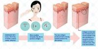 Sistema de rodillos de belleza 6 en 1, instrumento de agujas cosméticas y para el cuidado de la piel de titanio para la cara - details 3