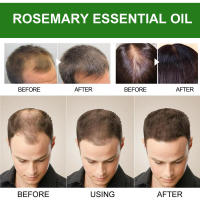 Tratamiento para el cuidado del cuero cabelludo con romero, raíces fuertes e hidratantes, bola de pelo gruesa para la línea del cabello - details 6
