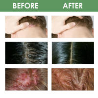 Cuidado de la oliva que alivia el enrojecimiento del cuero cabelludo, repara los folículos de acné, la picazón y la esencia para cabello apretado. - details 7