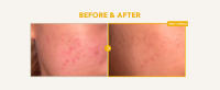 Vitamin C Serum Before After