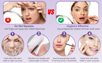 Kit de herramientas para espinillas, 10 piezas, extractor profesional de comedones para una fácil eliminación de espinillas, puntos negros, eliminación de zit, facial y nariz, kit de eliminación de acné con caja de metal - details 2