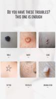 Pluma de plasma para belleza, eliminación de verrugas, pecas, nevos, puntos de acné, eliminación de manchas, lápiz láser de belleza para eliminación. - details 1