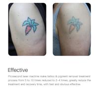 Láser Picosegundo Para Eliminación De Tatuajes Máquina De Láser Rojo/Azul Quema De Manchas Piel Pigmentada Eliminador De Vello Y Acné - details 10