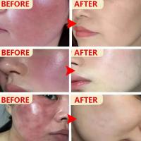 Crema de día correctora antienrojecimiento Facial, crema para el cuidado de la piel sensible a la picazón, crema hidratante para iluminar la Base, cosméticos - details 10