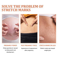Desaliniza el cuerpo, reparación de cicatrices de embarazo, crema suave y nutritiva para el cuidado de la piel - details 7