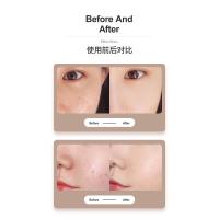 Utensilios para el cuidado facial,masajeador de radiofrecuencia facial dermapen,Masajeadores eléctricos de microinfusión - details 6