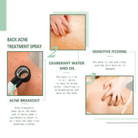 Spray reparador de acné en la espalda, aceite esencial para eliminación de acné, tratamiento de acné, Spray que se desvanece, marcas de acné, crema para el cuidado de la piel para todo tipo de piel, 120ml - details 4