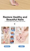 Dispositivo portátil de limpieza de hongos en las uñas, láser antihongos, dispositivo de eliminación de hongos en las uñas de los dedos de los pies de larga duración. Tratamiento casero ligero y rápido de 7 minutos para las infecciones por hongos en las u - details 1